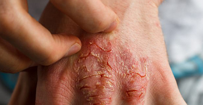 Psoriasis