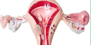 Fallopial Tubal Blockage