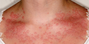 Eczema
