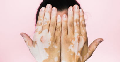 Leucoderma