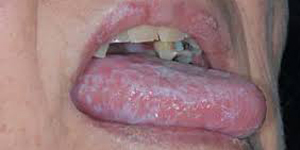 Lichen Planus