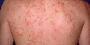 Urticaria