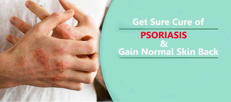What Is Psoriasis? Causes, Types and Treatments – Complete Guide!