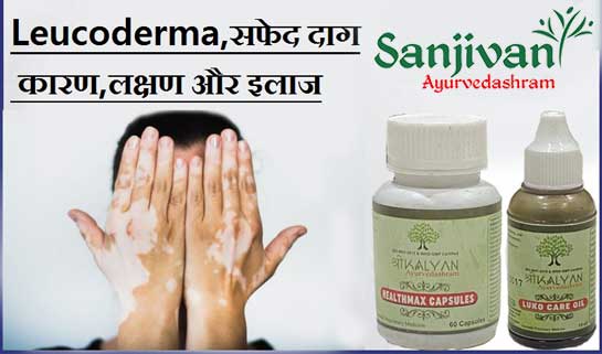 Leucoderma Treatment
