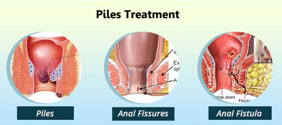 What Are The Painless Piles Treatments?