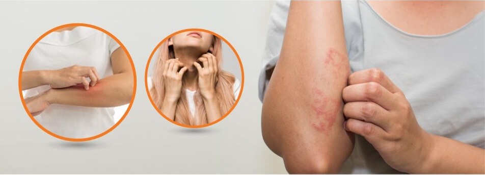 How to Cure Eczema with Ayurvedic Medicines?