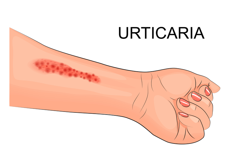 What Are The Different Causes As Well As Risk Factors Of Urticaria?