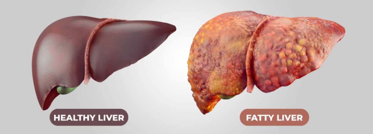 What is The Most Effective Diet To Avoid Fatty Liver Disease?