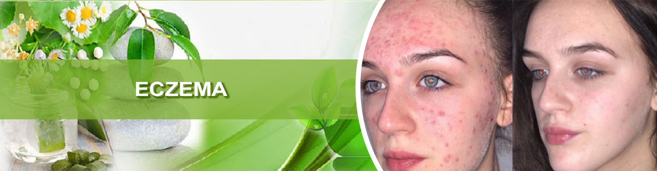 How to Cure Eczema Ayurvedic Medicines?